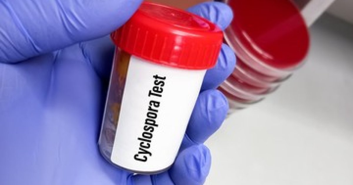 Perkembangan Kasus Cyclosporiasis di Amerika Serikat: CDC Konfirmasi Lebih dari 4.000 Infeksi Baru